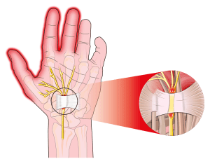 carpal tunnel physical therapy