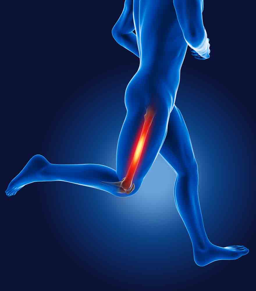 Managing IT Band Friction Syndrome running leg pain physical therapy oakland 128648288 1 managing it band friction syndrome chronic pain