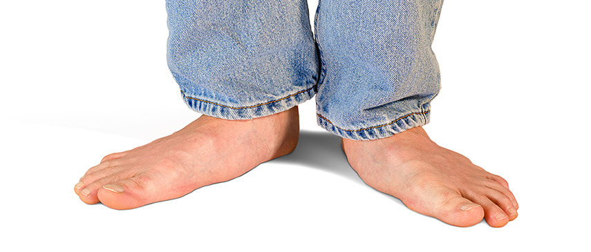 Flat feet: How physical therapy can help the pain