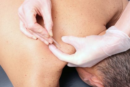 Dry Needling and Muscle Pain